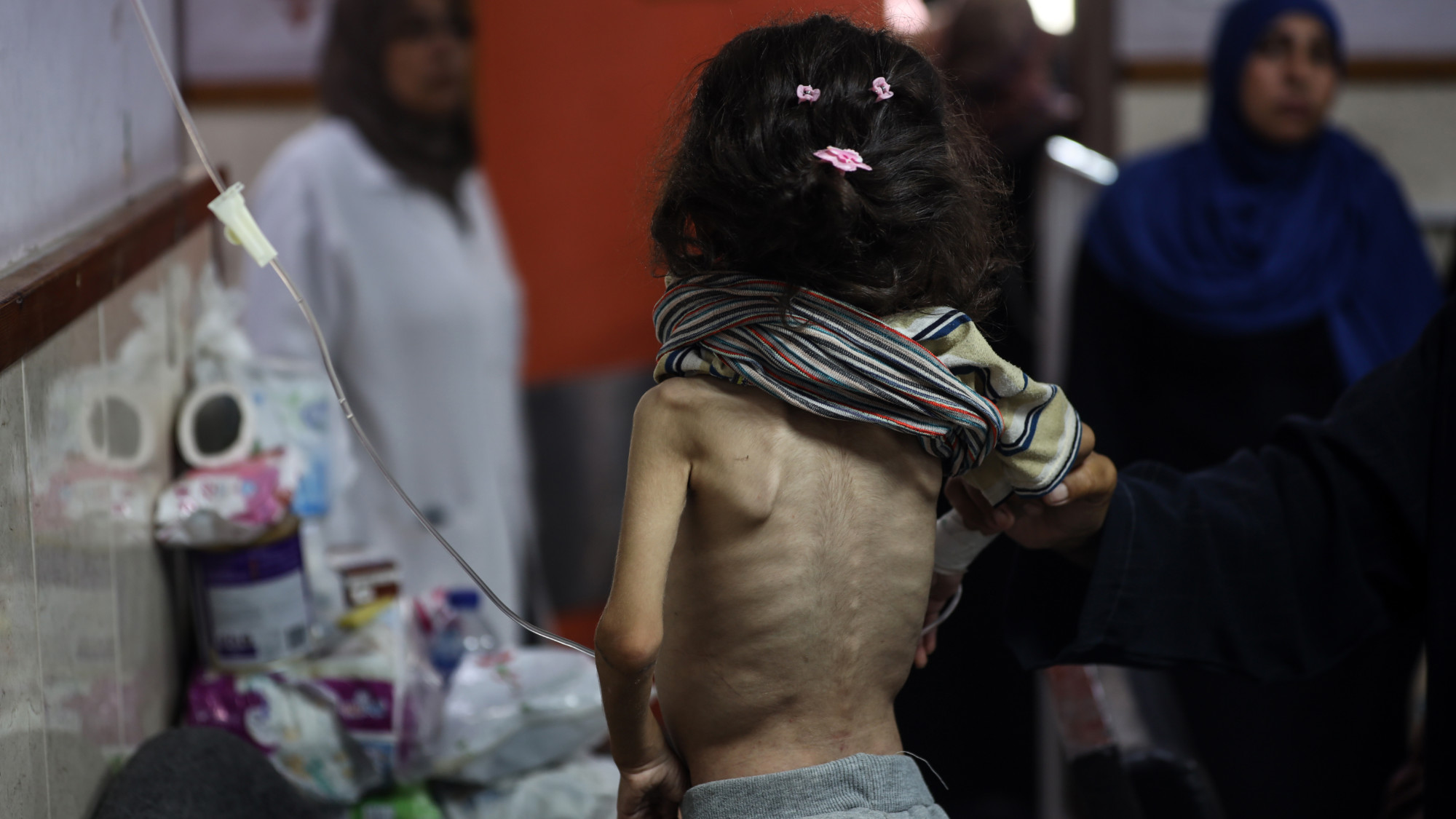 A Palestinian child suffering from malnutrition receiving treatment at Al-Aqsa Martyrs Hospital in Deir al-Balah on 1 June 2024 (Majdi Fathi/NurPhoto via Reuters)