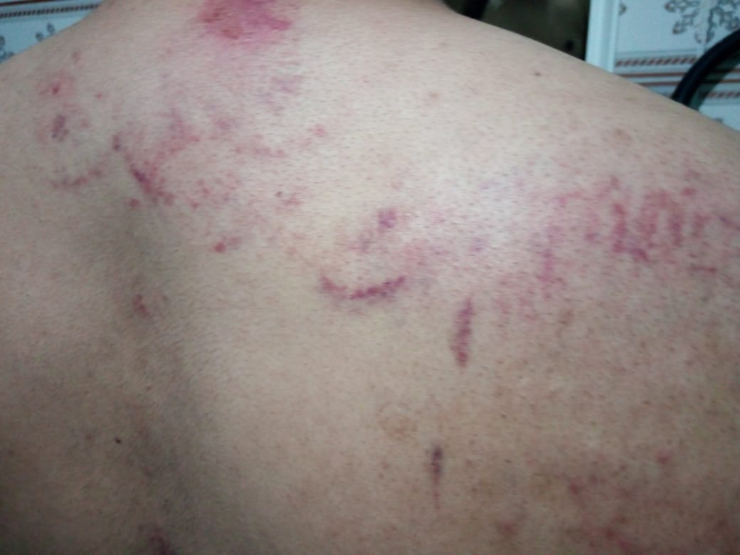 Ecchymoses et cicatrices sur le dos de Lwali Lahmad après sa détention par la police marocaine (Fondation Nushatta)