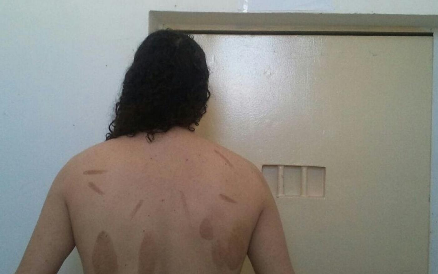 In prison in Morocco, Mohamed Hajib was tortured, as shown in this photo, with objects that left burn marks on his back (photo courtesy of Mohamed Hajib)