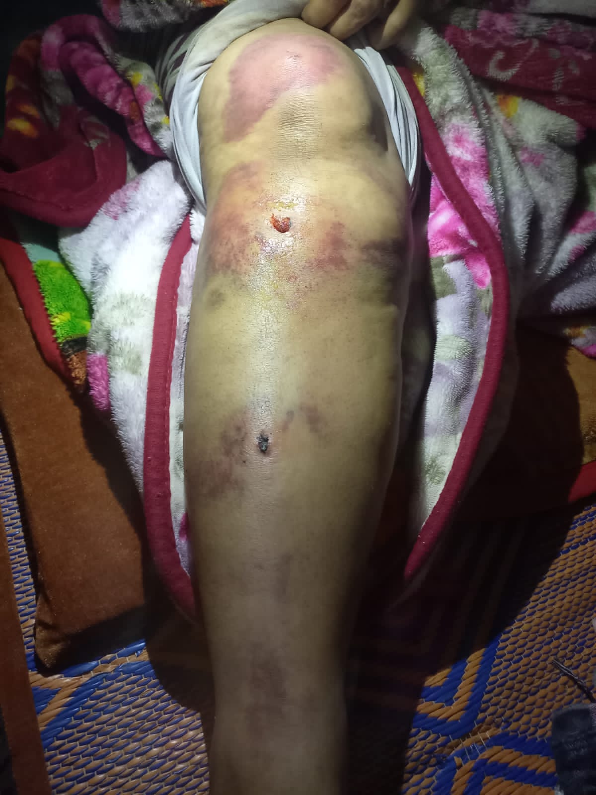 Photo de la jambe de Fatima al-Hafiz, après avoir été battue par la police marocaine (Fatima al-Hafiz)