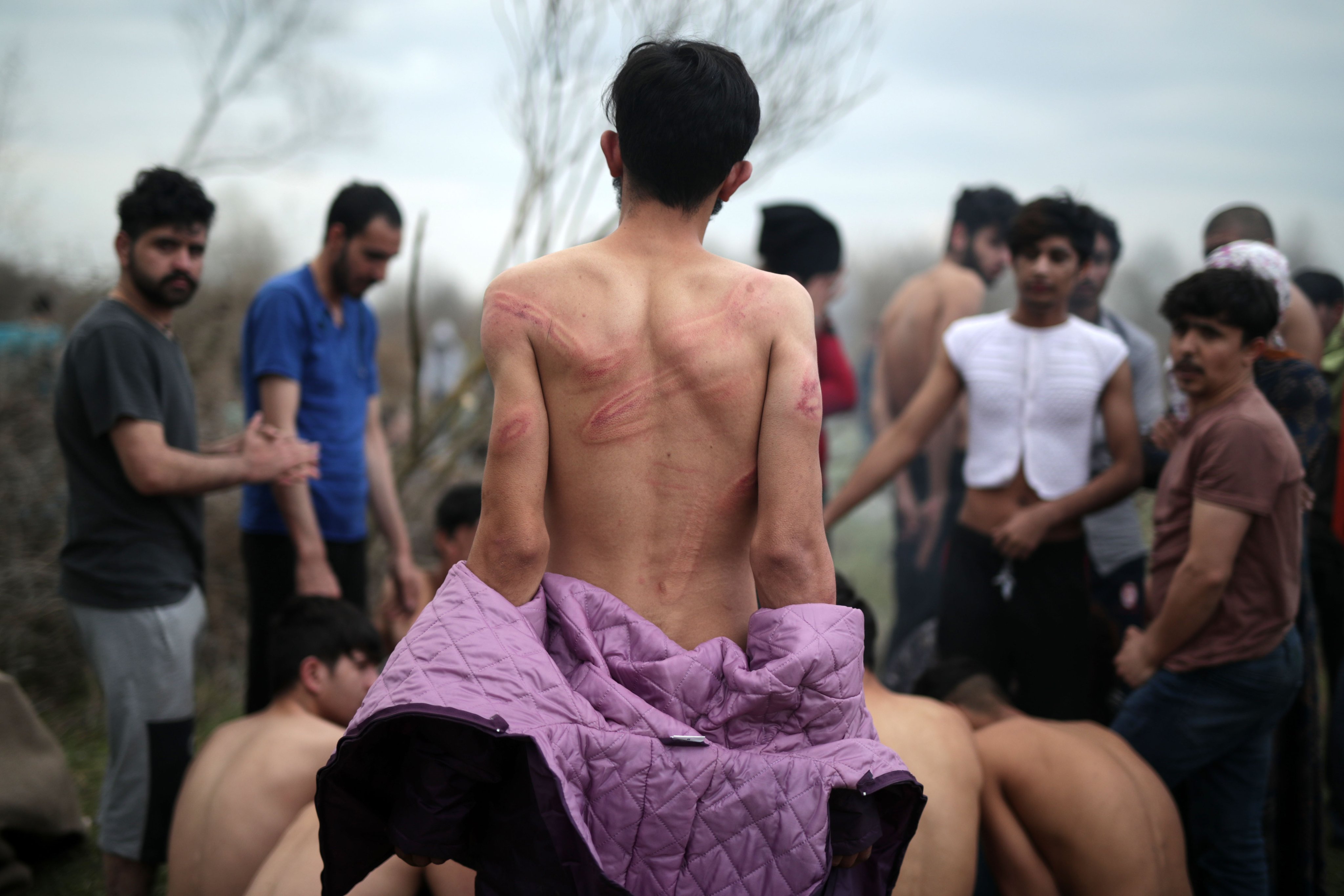 Un réfugié montre des marques sur son dos qui résulteraient de coups infligés par les garde-frontières grecs (TRT World/capture d’écran)
