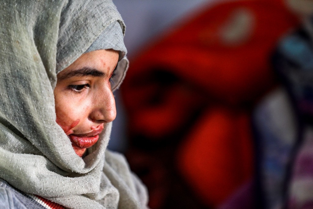 Al-Anoud a presque perdu l’œil gauche et son visage et corps ont été atteints de profondes brûlures (AFP)
