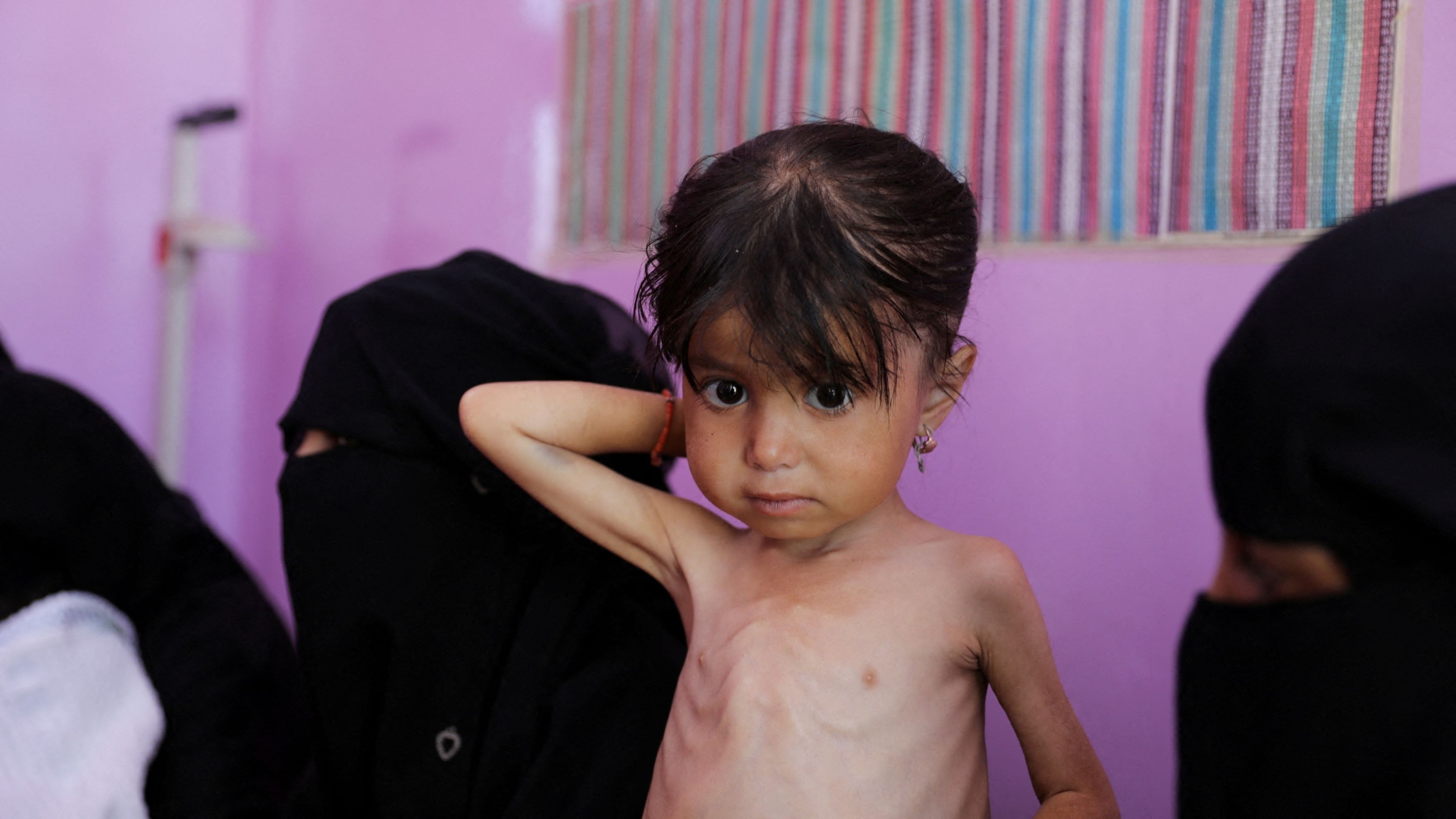 A malnourished girl waits at a measurement room of a hospital in Sanaa as Yemeni children face the risk of medical complications amid high levels of food insecurity, on March 2 2024 (Reuters/Khaled Abdullah/File Photo)