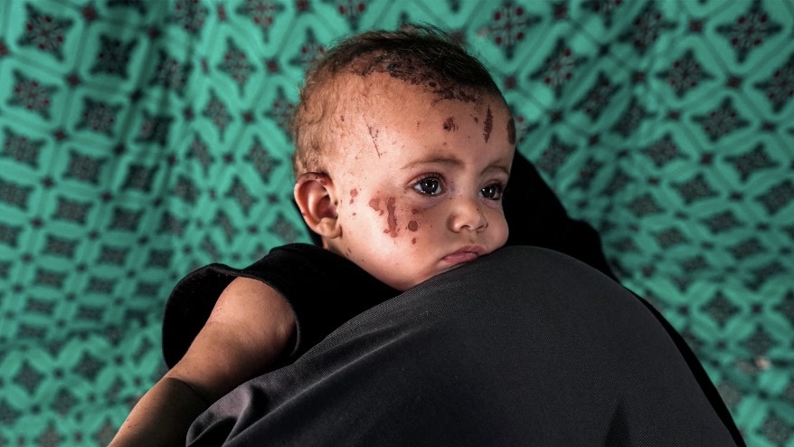 Palestinian toddler Rim Abu Hayya, the sole survivor of her family after Israeli bombs hit their house, is carried in a tent shelter in Khan Younis, 13 August 2024 (Bashar Taleb/AFP)