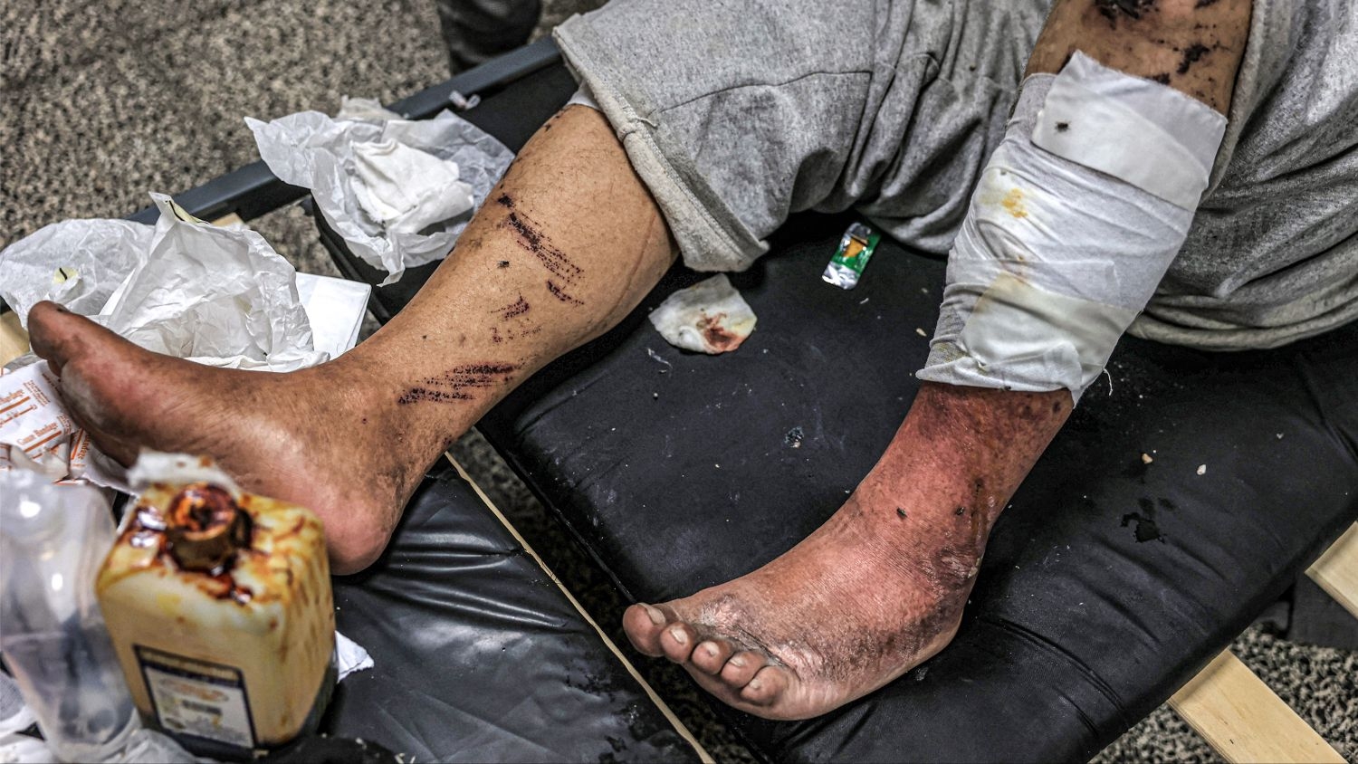 An injured Palestinian among those detained by the Israeli military awaits treatment for his injuries at al-Najjar hospital in Rafah in the southern Gaza Strip on 24 December 2023