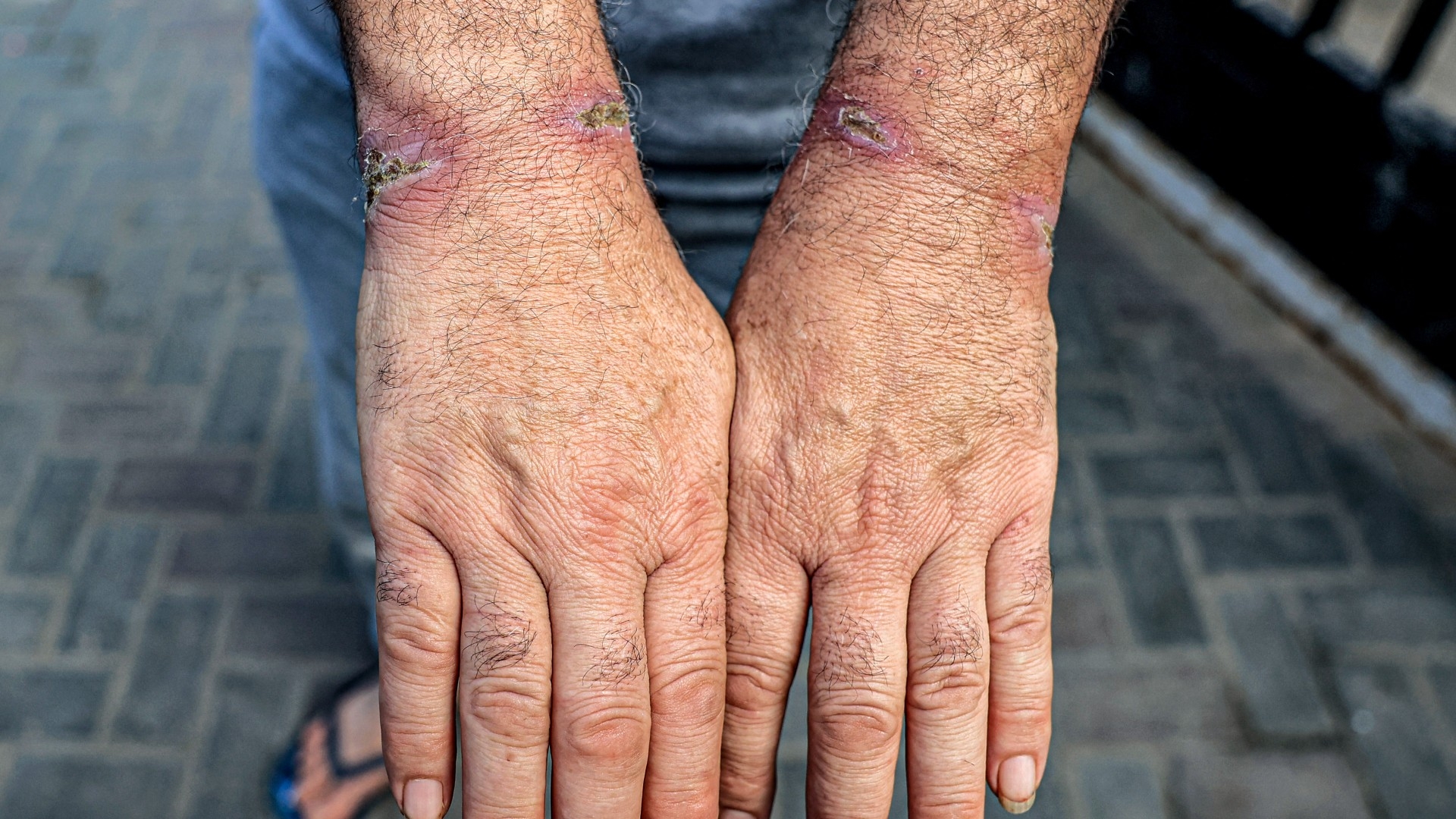 A man detained by the Israeli military in the northern Gaza Strip shows off the injuries on his wrists at al-Najjar hospital in Rafah in the southern Gaza Strip on 24 December 2023 (AFP/Said Khatib)